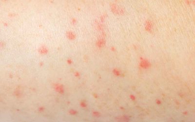 ¿Cómo son las picaduras de pulgas?